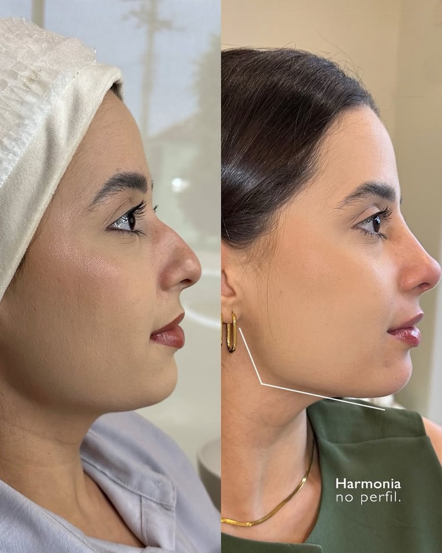 Antes e depois — Rinomodelação