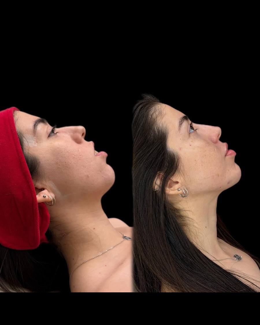 Antes e depois — Harmonização Facial
